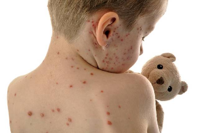 Américas perdem status de região livre do sarampo; doença é altamente transmissível e pode matar